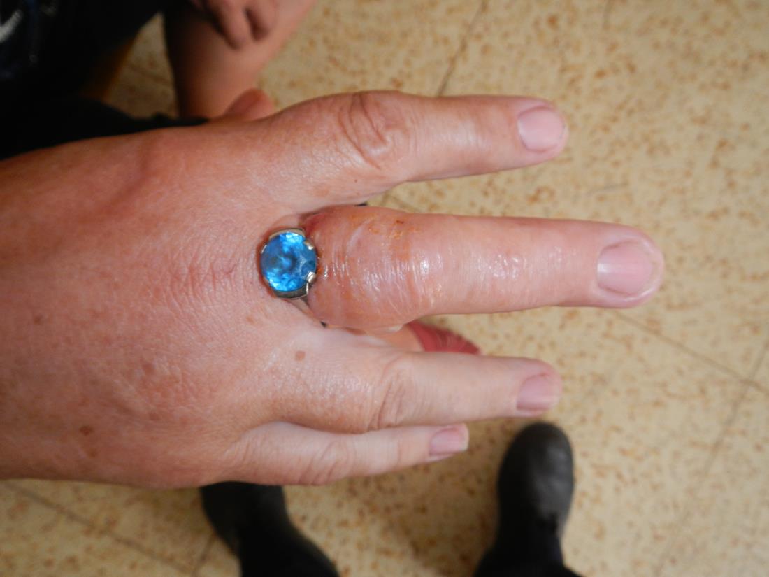 1 Odstranění prstenu +vosí štípnutí, Týn nad Vltavou - 24. 8. 2015 (1).jpg
